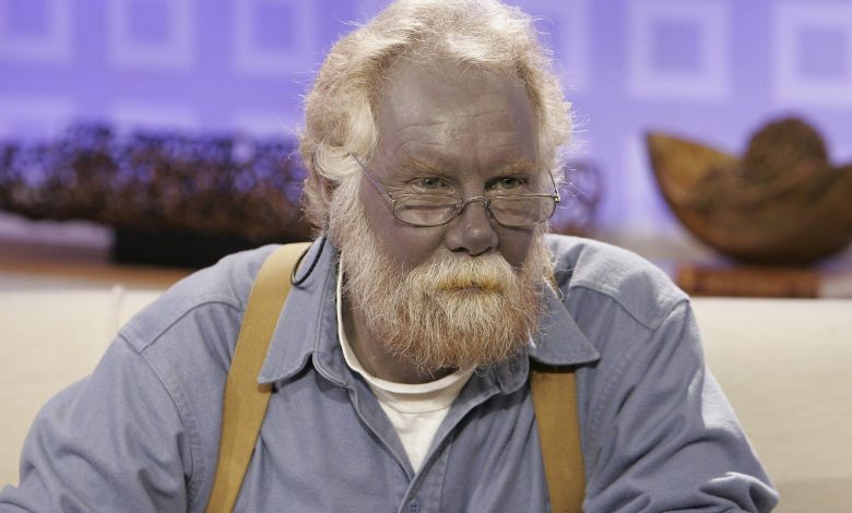 Argyria: Penyakit langka yang membuat orang menjadi biru