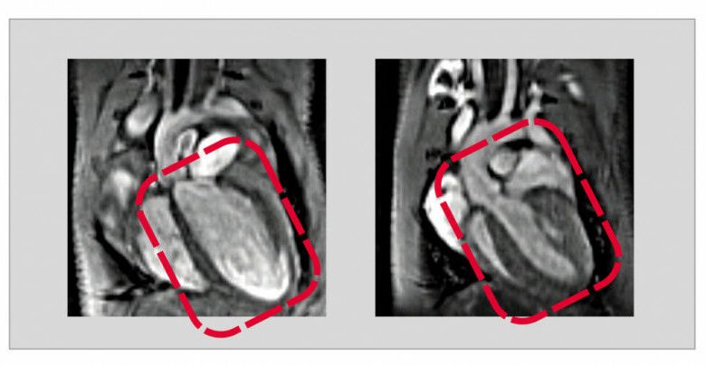 Konsentrasi USP5 rendah menyebabkan kelemahan otot jantung. Gambar tersebut menunjukkan gambar o