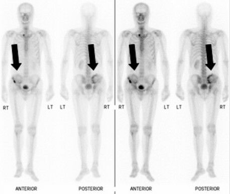 Scintigraphy (Hak Cipta: Wikimedia. PMID 20500842. Akses Terbuka di bawah CC-BY-2.0)