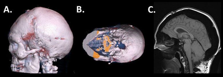 A. Pemindaian CT 3D dari tengkorak dari pasien sclerosteosis. Perhatikan pertumbuhan berlebih tulang