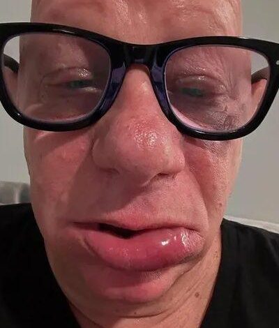 Jeff Ross menunjukkan reaksi alergi