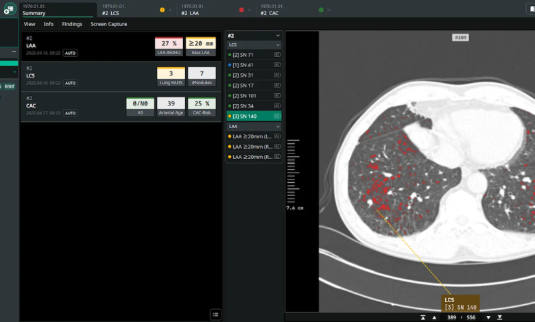 Skrining kanker paru -paru Coreline Soft AI ditambahkan ke platform Calantic Bayer
