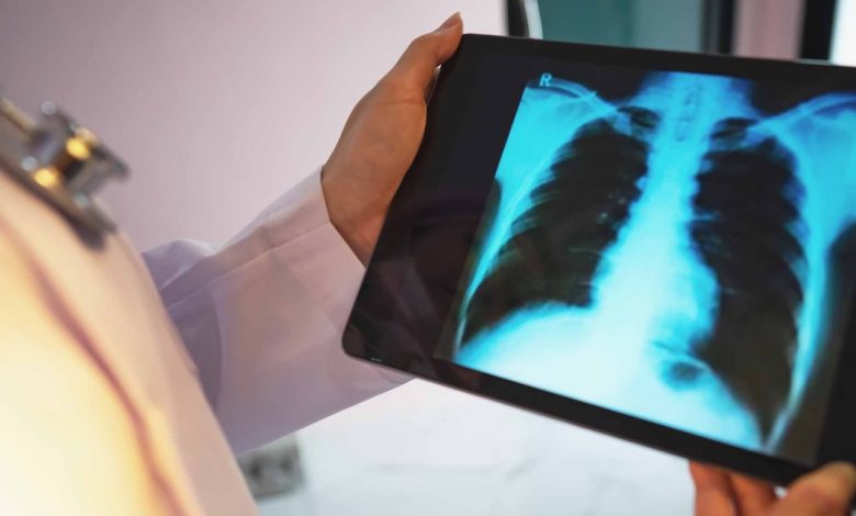 Viz.ai mitra dengan regeneron, sanofi untuk mempelajari alat COPD