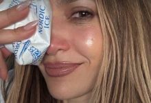 Jennifer Lopez menunjukkan cedera di wajahnya