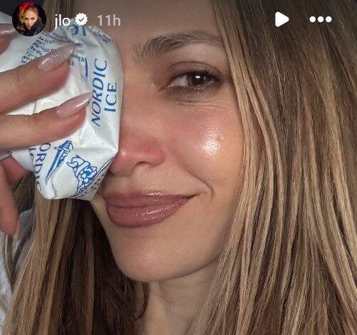 Jennifer Lopez menunjukkan cedera di wajahnya