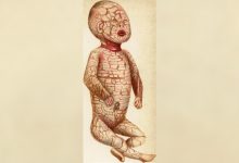 Harlequin Ichthyosis: Penyakit genetik langka yang memberi bayi 'skala' yang keras