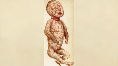Harlequin Ichthyosis: Penyakit genetik langka yang memberi bayi 'skala' yang keras