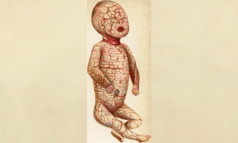 Harlequin Ichthyosis: Penyakit genetik langka yang memberi bayi 'skala' yang keras