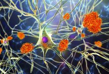 Ada tes darah baru untuk Alzheimer. Inilah semua yang perlu Anda ketahui tentang itu.